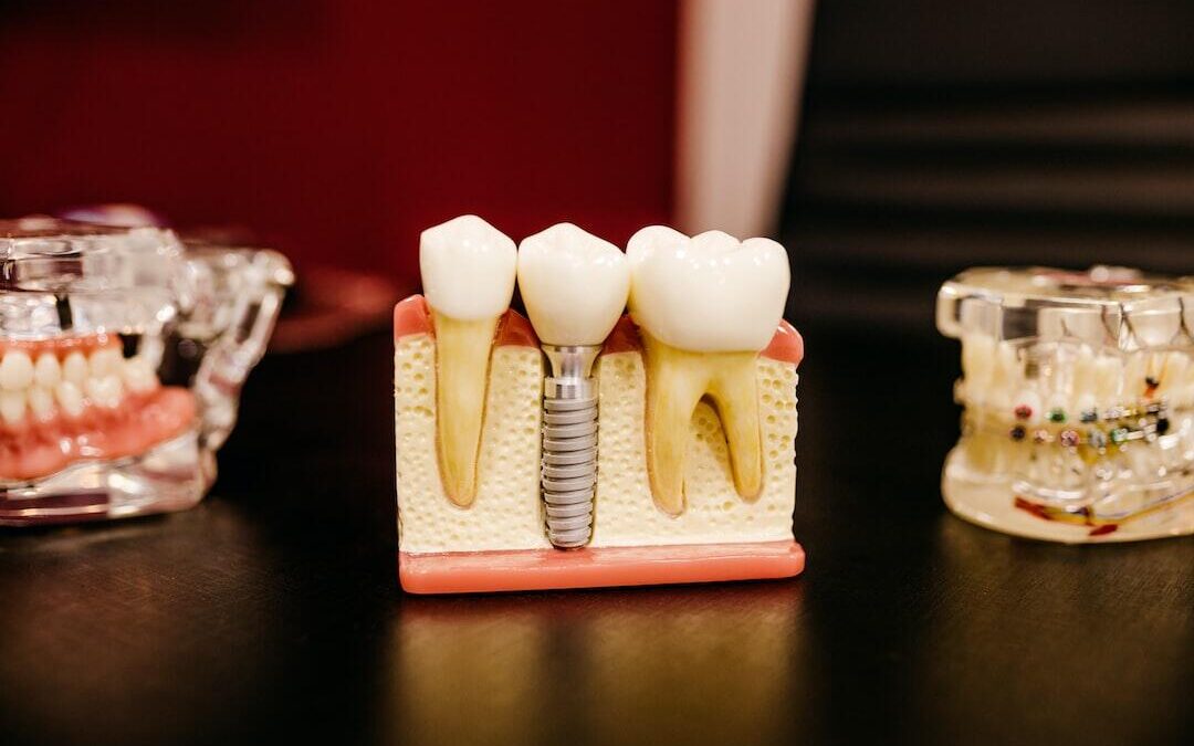 Don’t Settle for Cheap Implants When It Comes to Teeth—Here’s Why